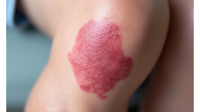 Gros plan sur une zone de peau affectée par le psoriasis, montrant des plaques rouges bien définies recouvertes de squames argentées, soulignant l'aspect inflammatoire de la maladie.